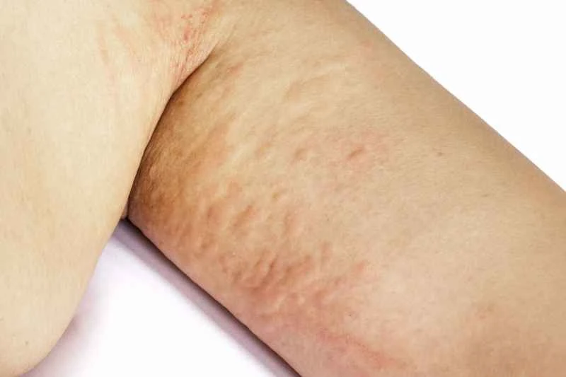 What are the symptoms of chronic urticaria?