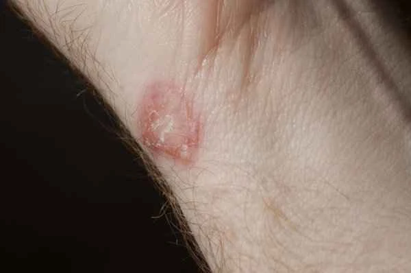 How to treat superficial keloids