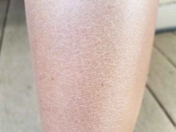 White patches on the inner thighs