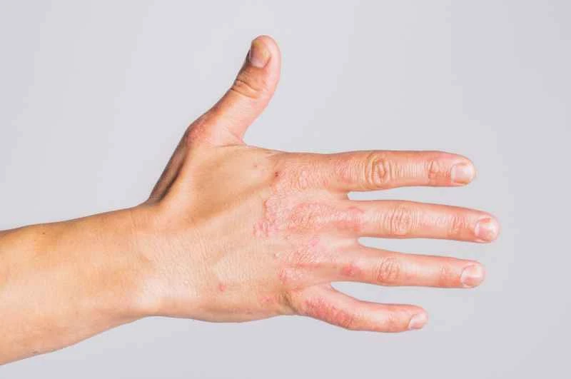 How to treat papular urticaria and what ointment to use?