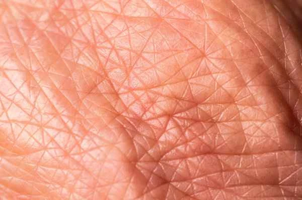 What is keloid spasm?