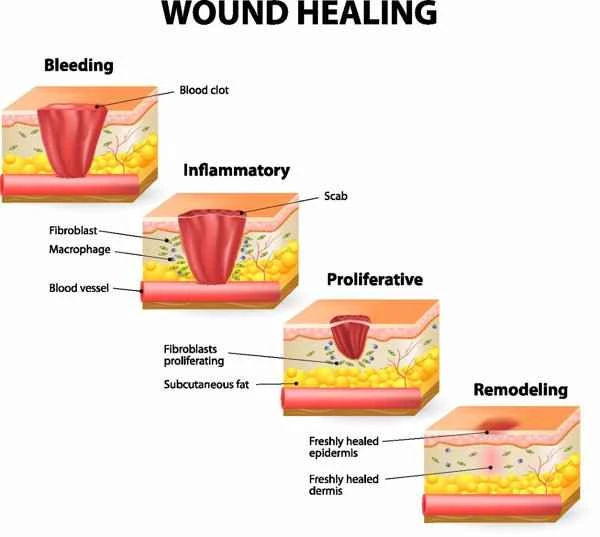 Stages and characteristics of hypertrophic scars