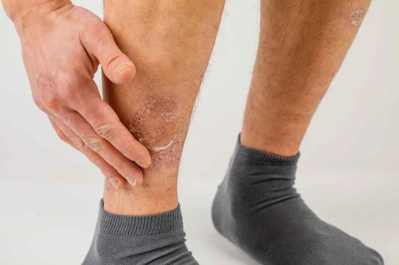 What causes psoriasis?