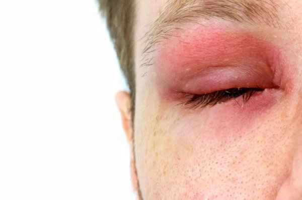 What to do if you get stung on the head by a gourd wasp