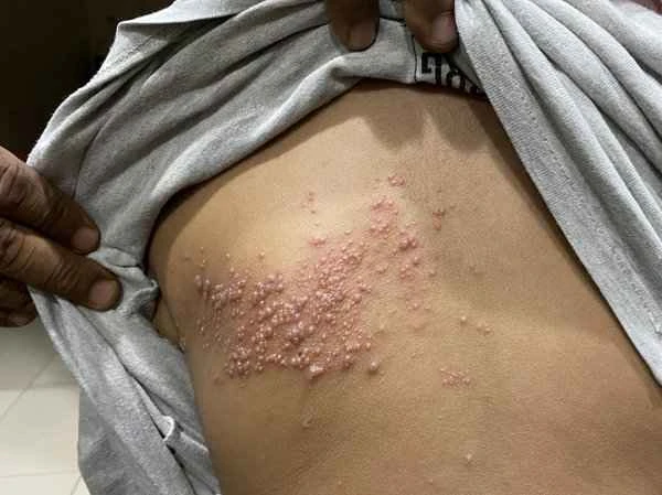 Is it shingles if it's a little painful but not itchy?