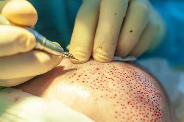 How long does it normally take for surgical scars to stop healing?