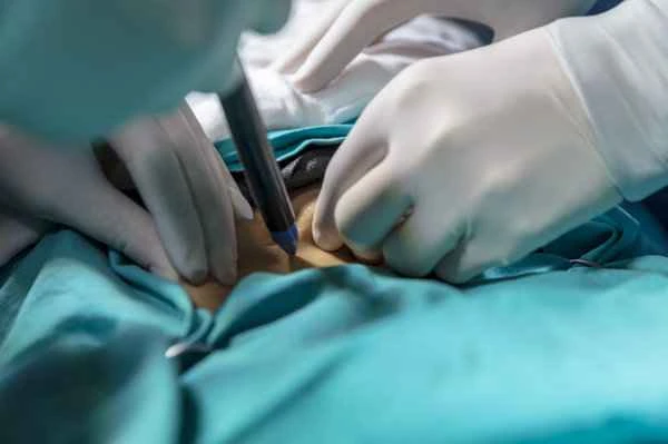 How to remove keloid scars on the chest