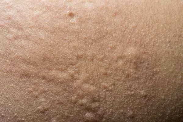 Treatment for refractory urticaria