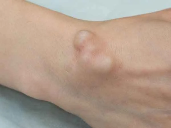 How can I get rid of cysts on my hands?