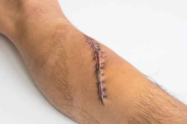 How to remove raised scars