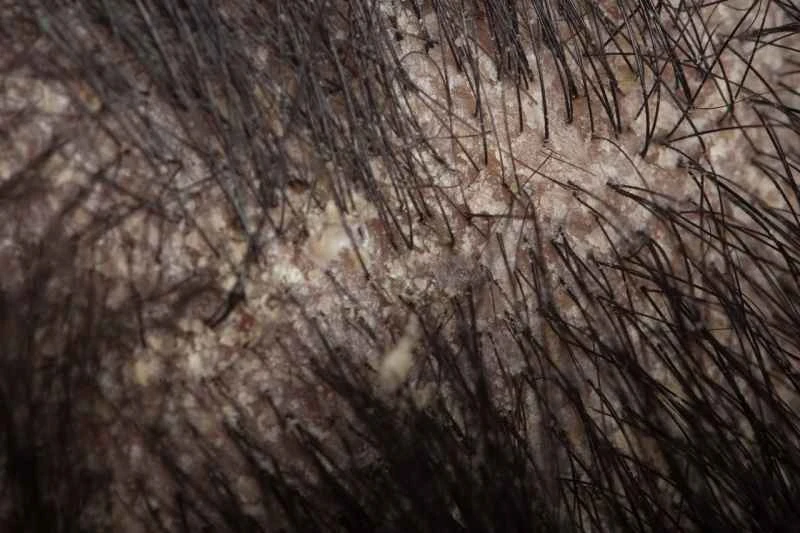 Can scalp psoriasis spread to the rest of the body?