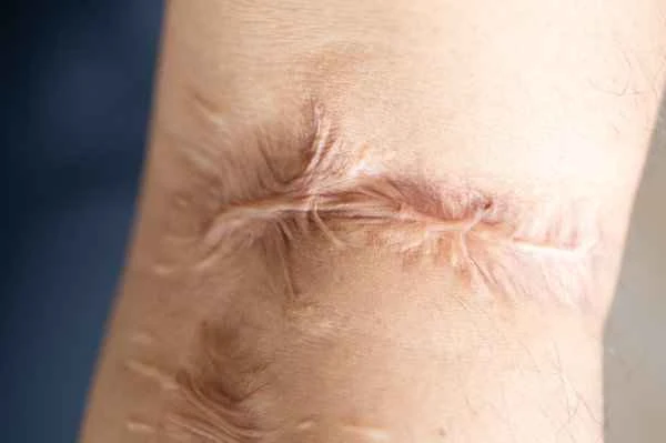 How to treat patchy scar adhesions?