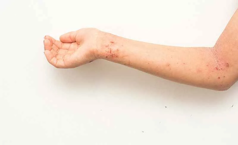 What causes urticaria in children?