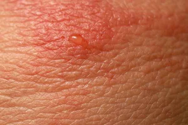 Can Piconazole cure scrotal eczema?