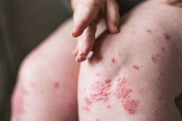 How to treat eczematous urticaria?