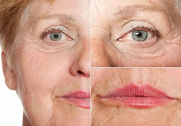 Will Botox injections eliminate wrinkles?