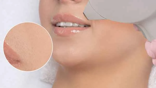 How to remove acne scars on the jawline