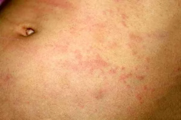 How long does it take to treat acute urticaria?