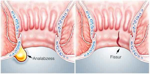 What to do about mucosal depression scars?