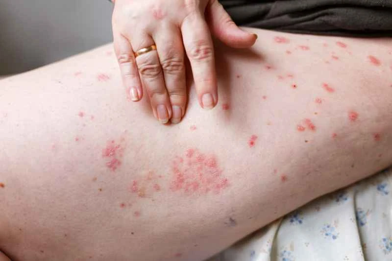 Is plaque psoriasis contagious?