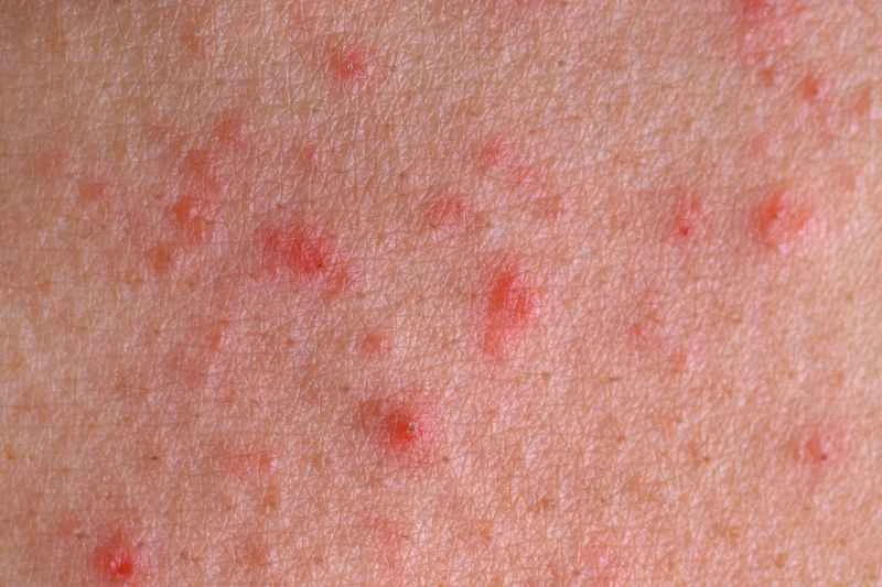 Is eczema in children contagious and how is it transmitted?