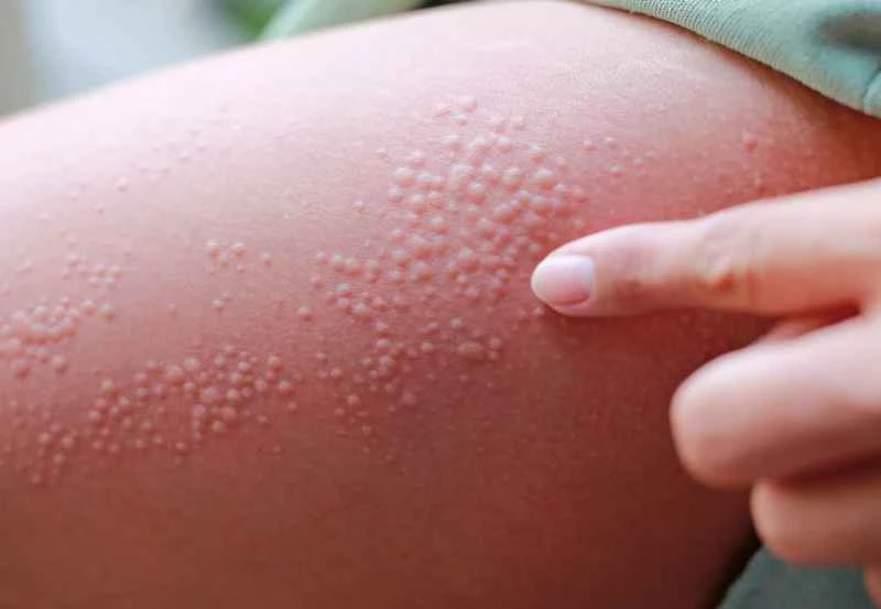 Is dry eczema contagious?