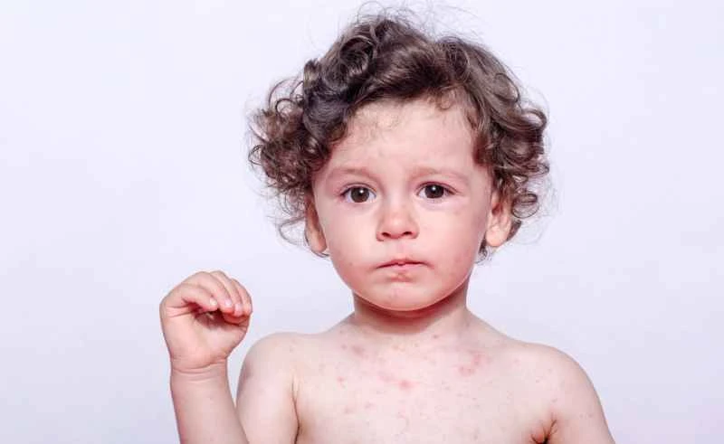 What does eczema look like in children?