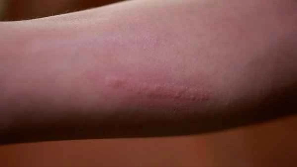 Is papular urticaria contagious?