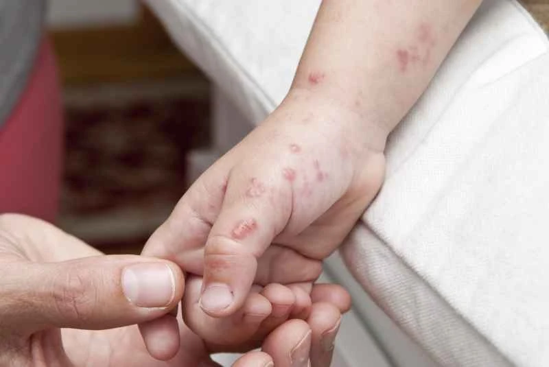 How to treat allergic urticaria in children most quickly and completely?