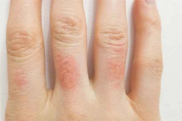 What causes finger warts?