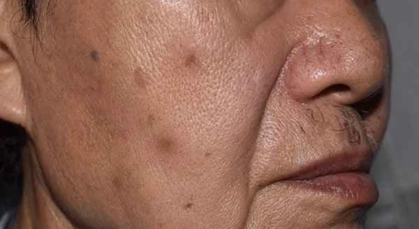 Be wary of blue veins appearing on both sides of the cheeks