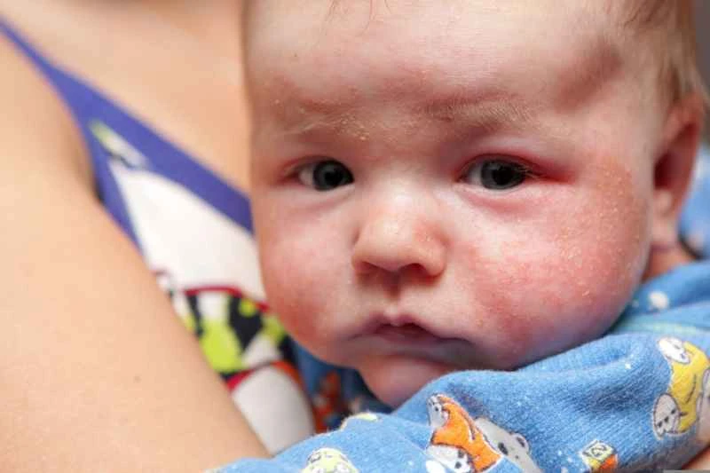 What to do if my baby's eczema keeps recurring?