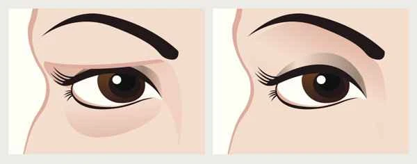 How to remove scars around the eyes?