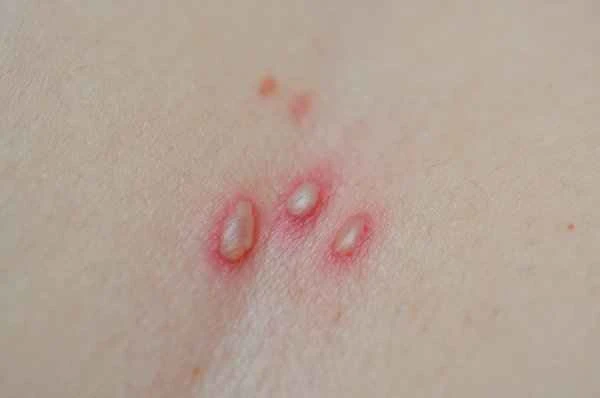 What to do if you have shingles