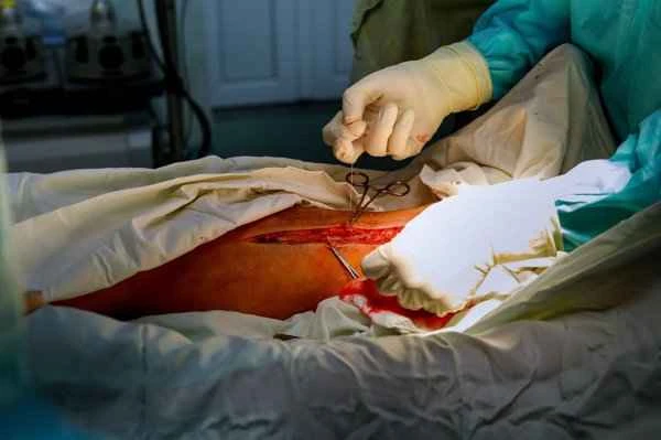 How to prevent scar recurrence