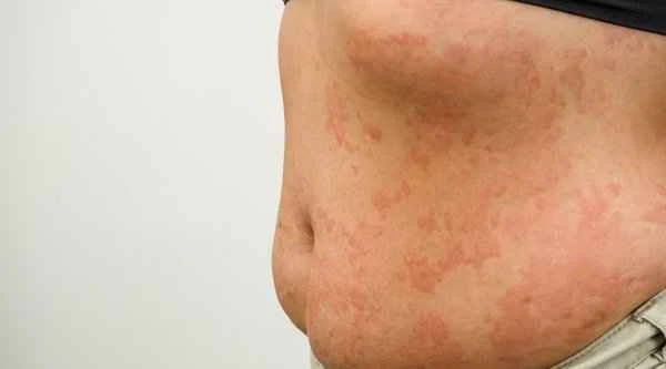 What to apply for papular urticaria