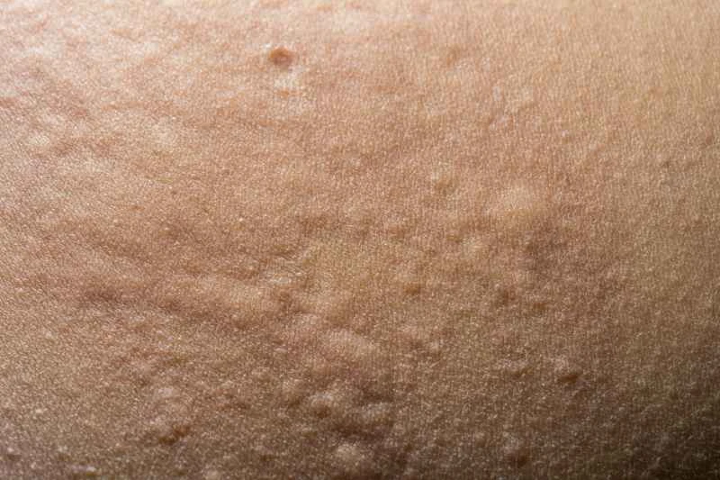Can urticaria lead to death?
