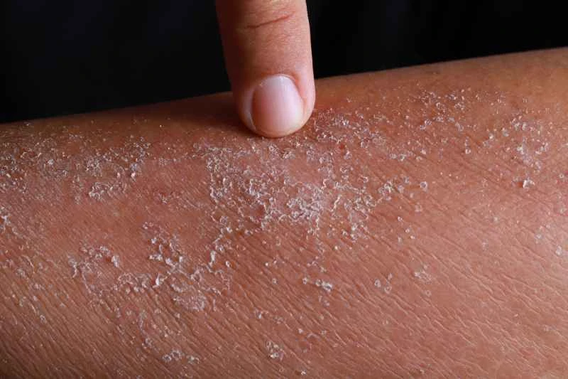 What to do if eczema keeps recurring for months?