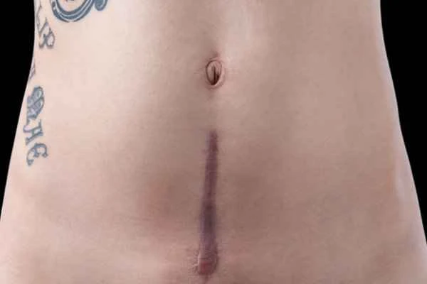 How to permanently remove scars