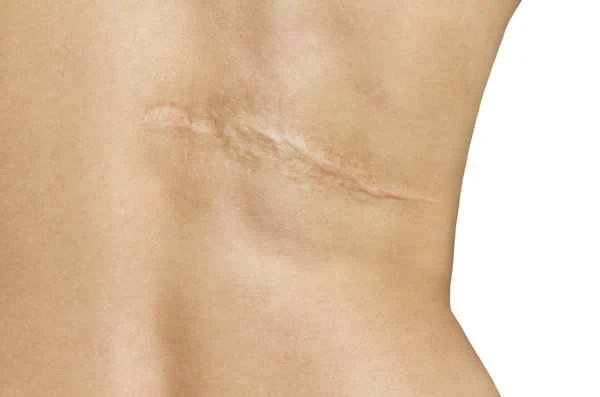 How to treat itchy scar tissue