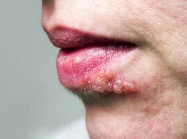 Will it hurt after applying Hirudoid cream for cheilitis?