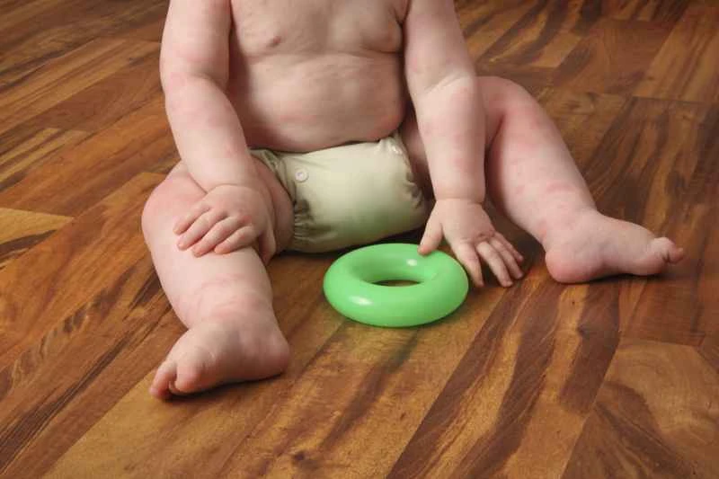 Why did I suddenly get hives?