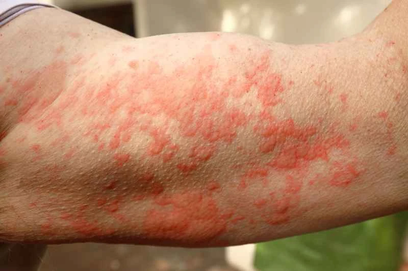 What are the symptoms of chronic urticaria?