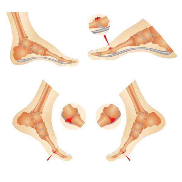 How to treat toe traction scars