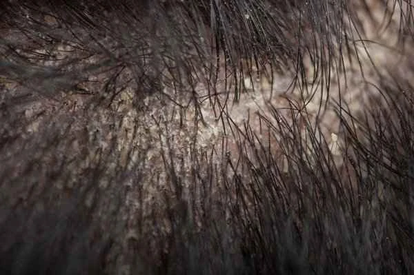 Is seborrheic dermatitis the same as dandruff?