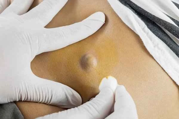 How to cover up keloid scars on the back