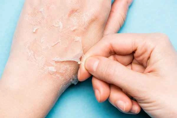 How to remove scars with ointment