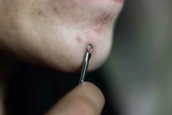 How to remove acne scars along the jawline?