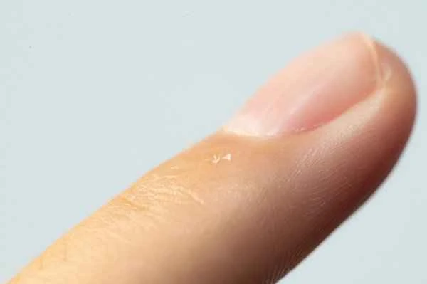What causes finger warts?