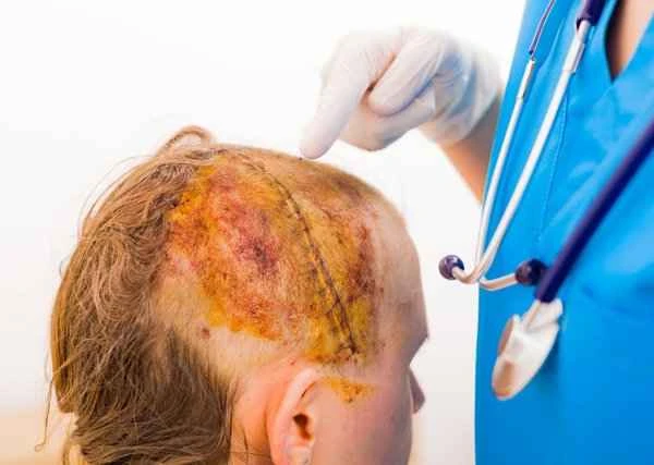 Do I need to take an X-ray of the head if I have shingles?